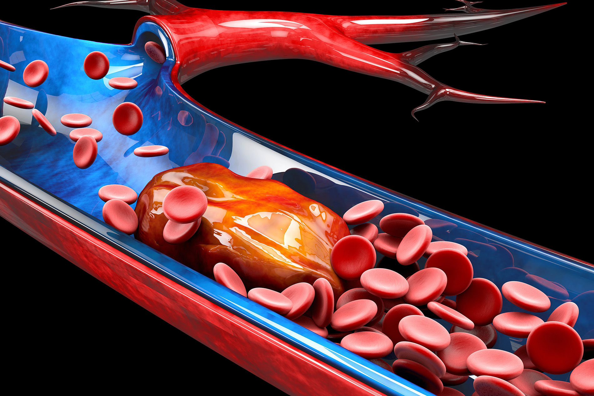 Medical illustration of blood clot in deep vein