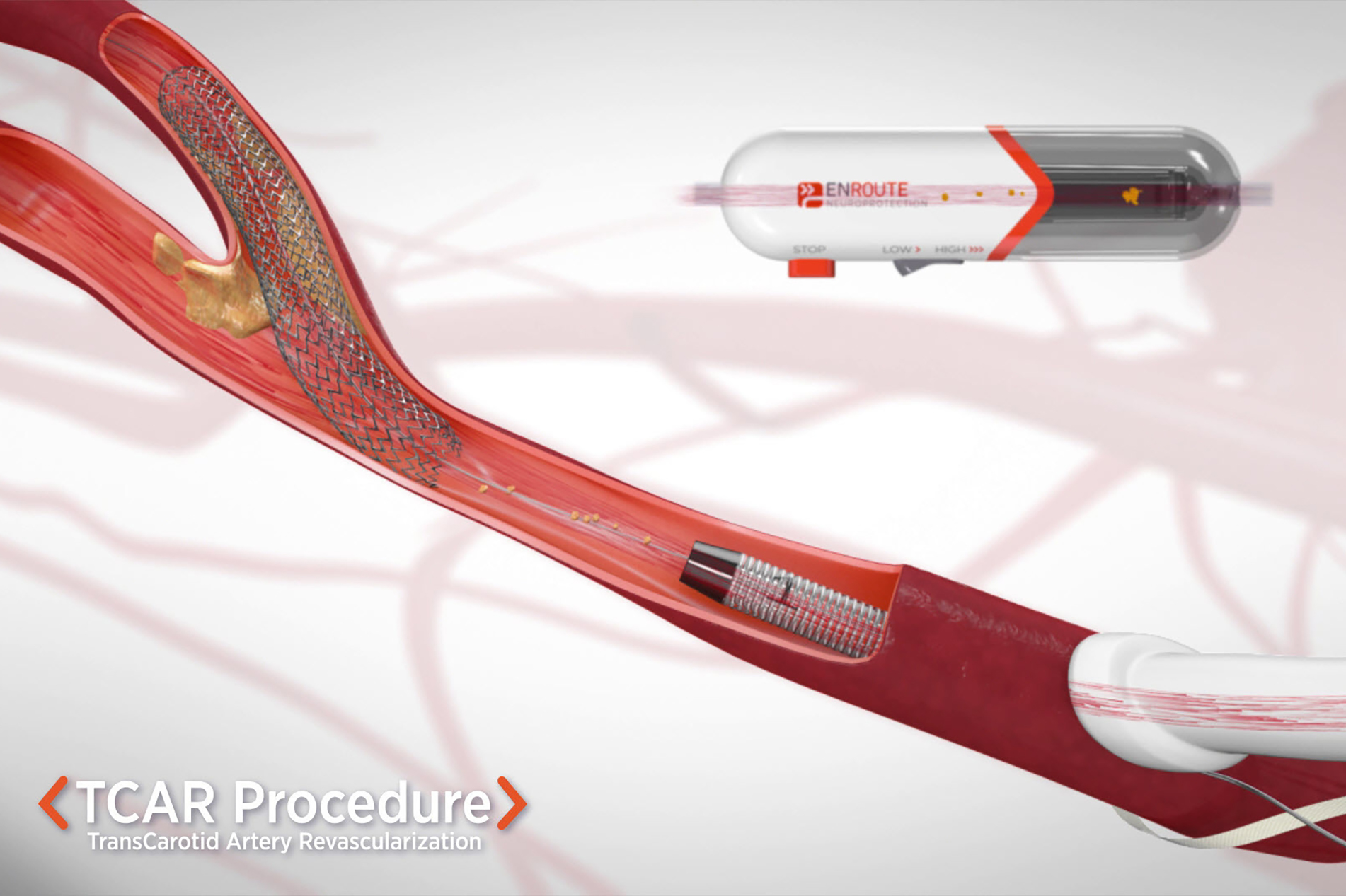 Medical illustration of TCAR procedure 