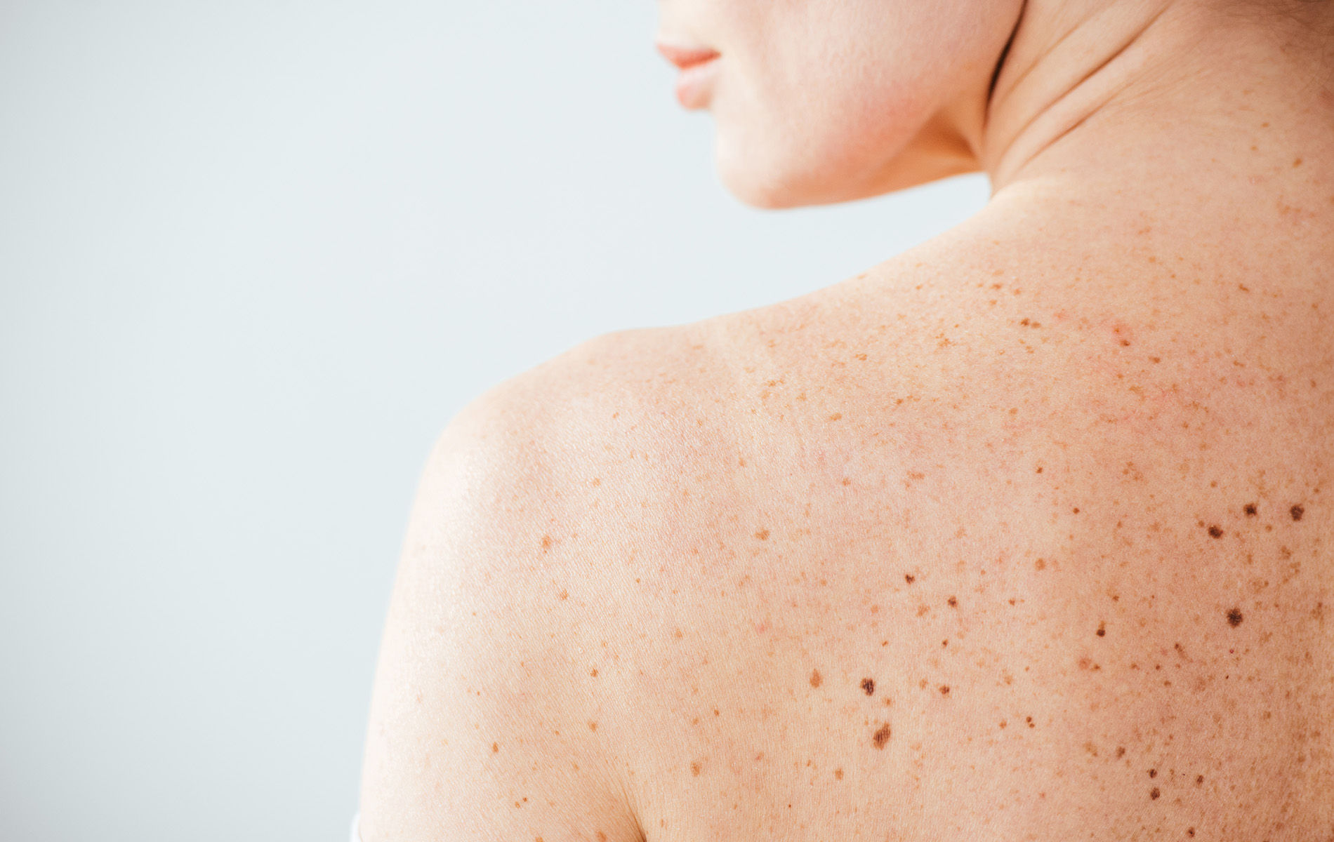 Woman's back with moles