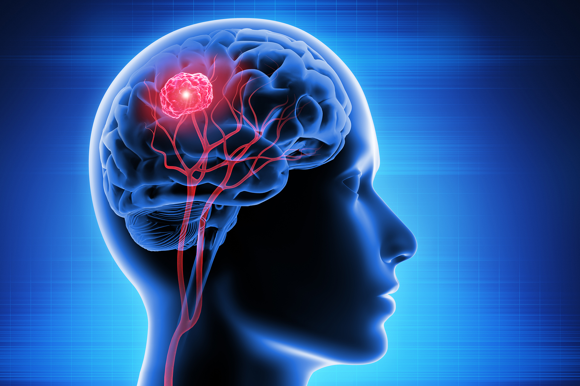 Abstract image of cross section of brain with tumor