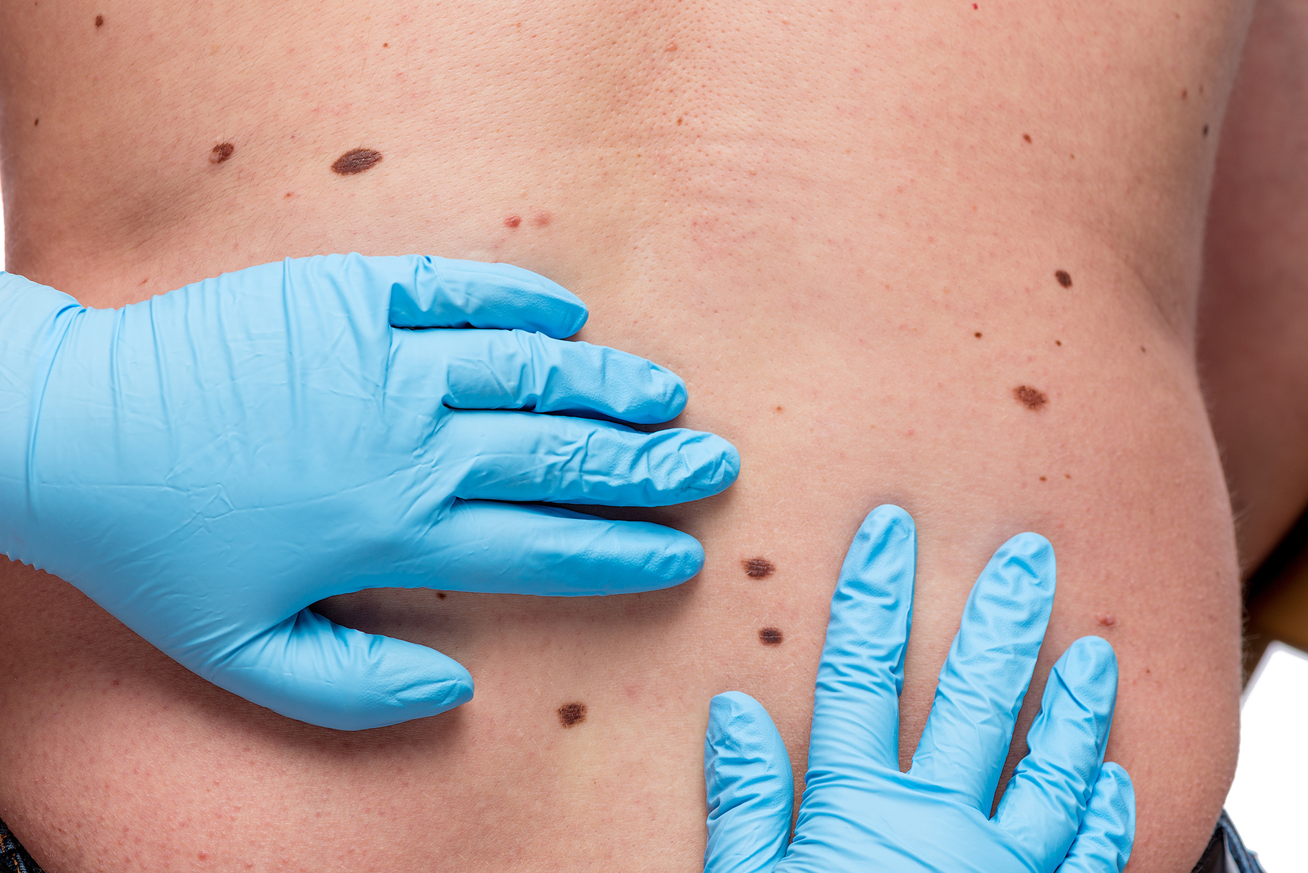 Doctor examining moles on patient's back