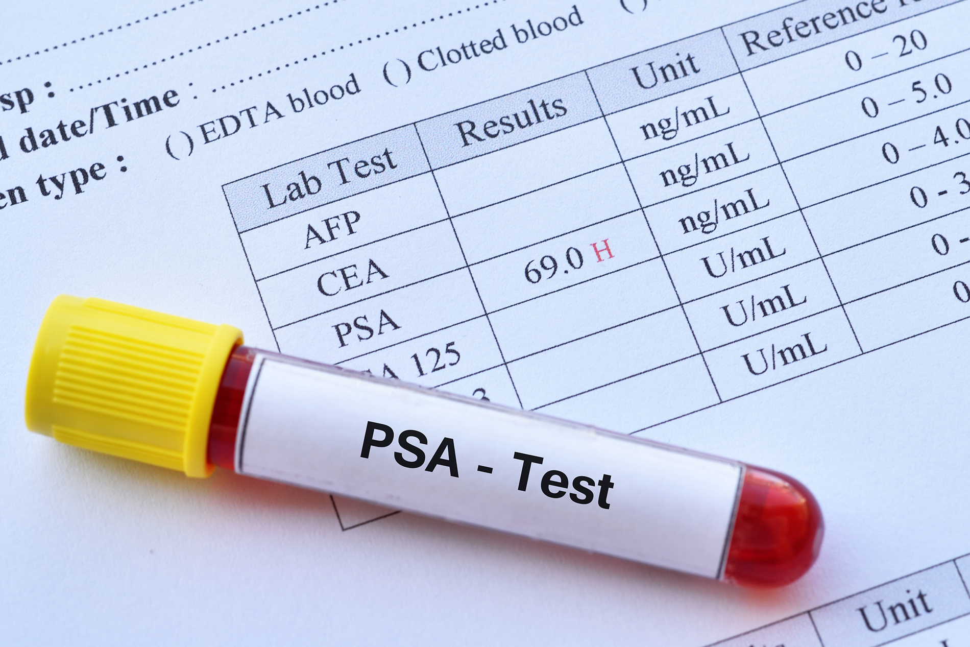 PSA Test Result