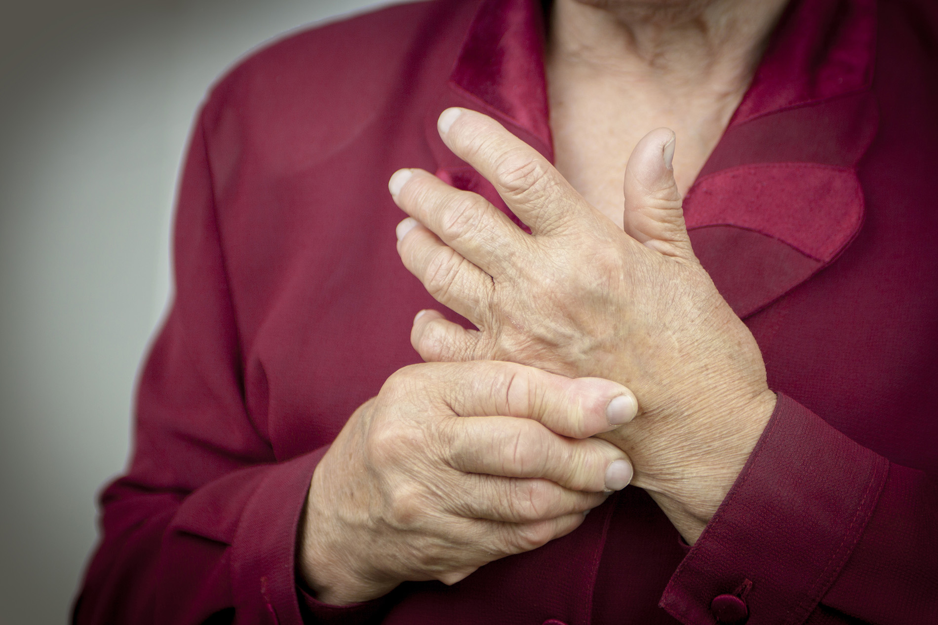 Hands of woman with rheumatoid arthritis