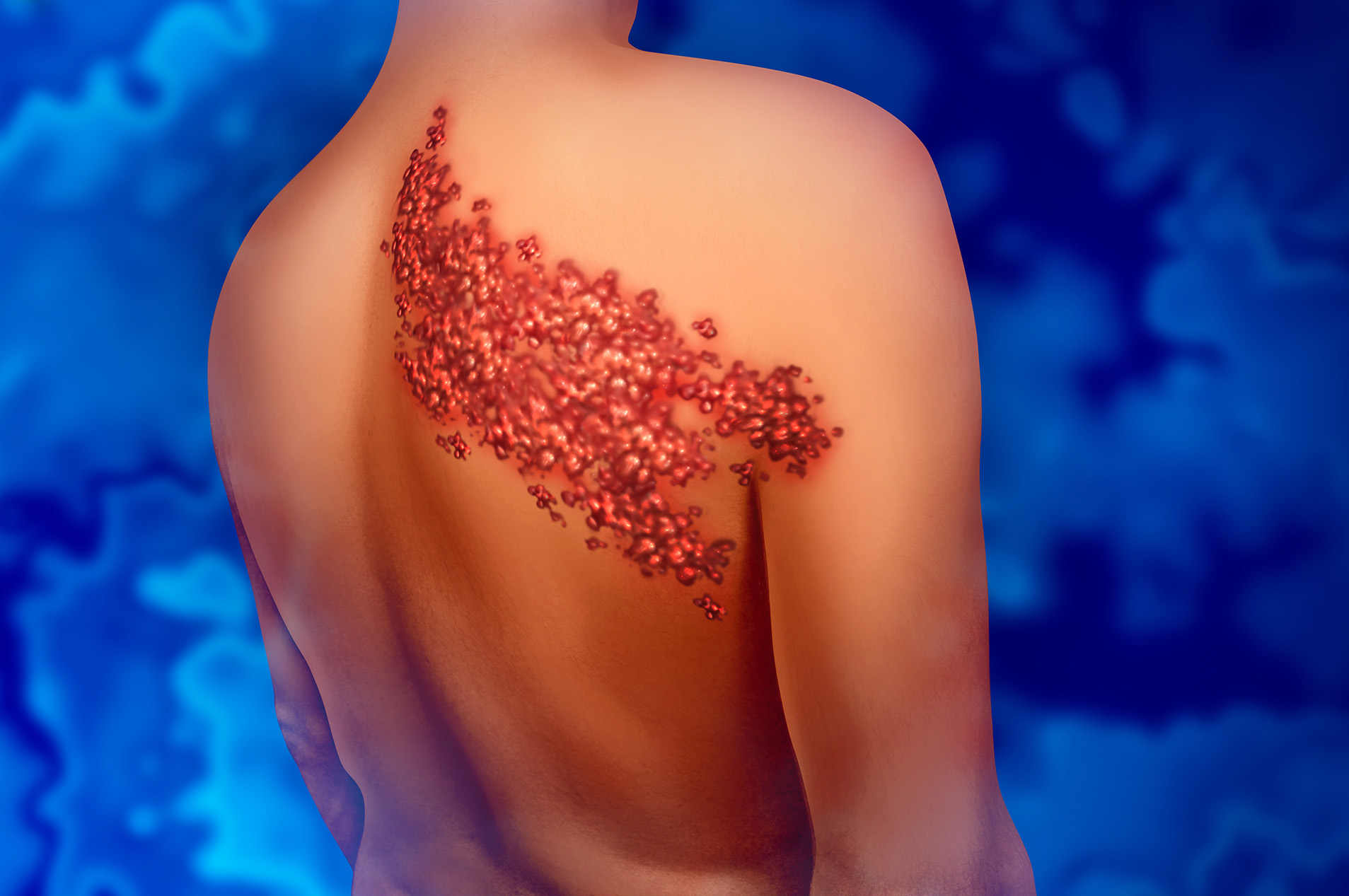 Illustration of shingles on man's back
