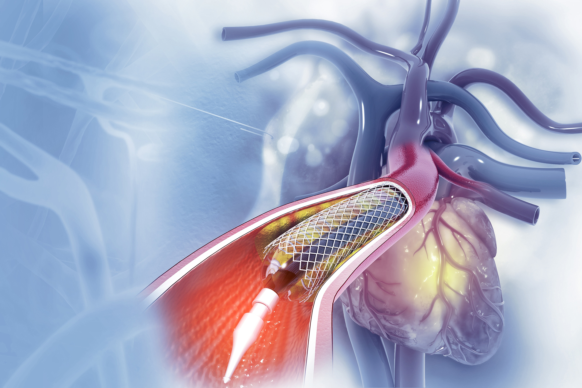 Medical illustration of cardiac catheterization