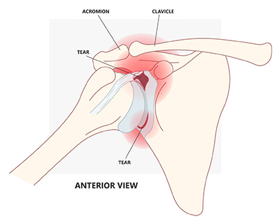 Anatomical illustration of torn shoulder labrum