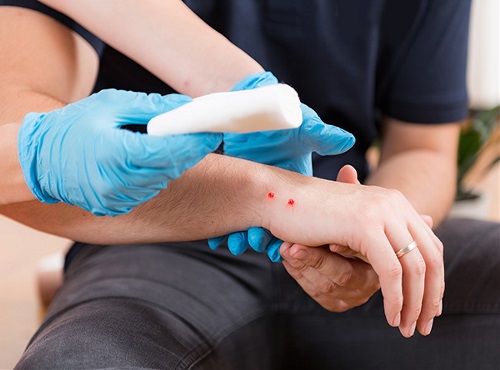 arm with puncture wounds from snake bite